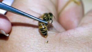 استفاده از زهر زنبور عسل