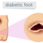 A human foot with diabetic
