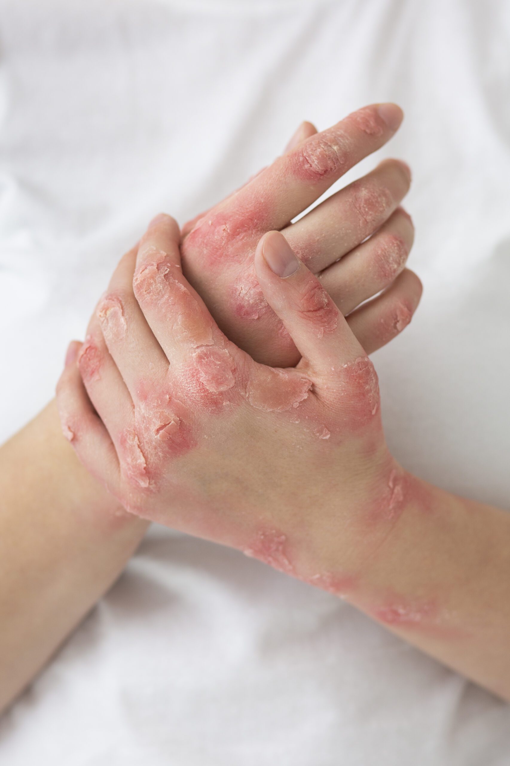hands patient suffering from psoriasis scaled